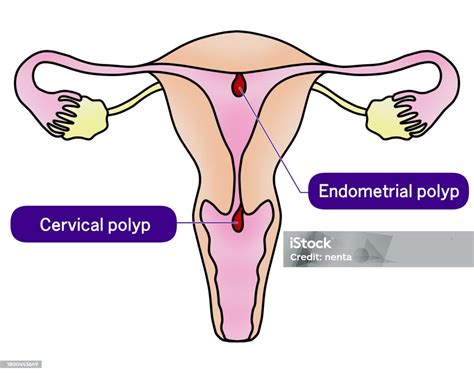 Illustration Of Endometrial Polyp And Cervical Polyp Stock Illustration