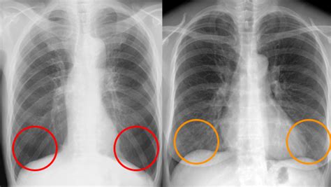 肺気腫を知って胸部レントゲンの第一印象を読影に繋げる RadioGraphica