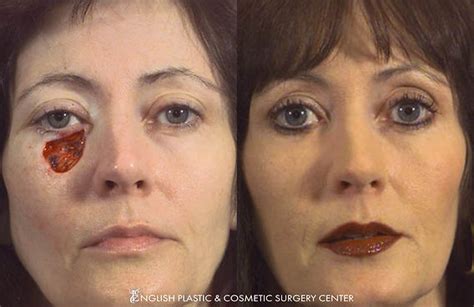 Mohs Surgery Before After English Plastic Cosmetic Surgery