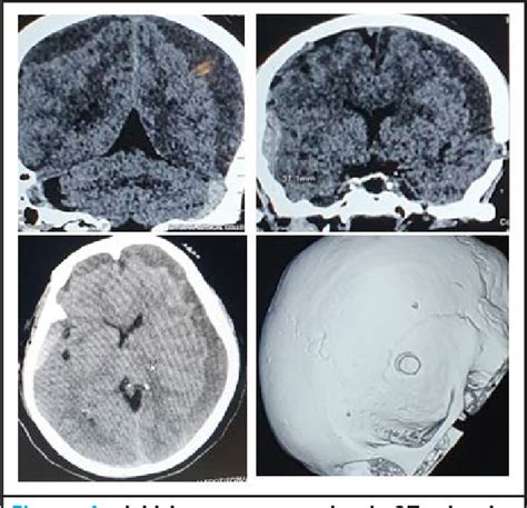 Figure 1 From Acute On Chronic Bilateral Subdural Hematoma In A Woman