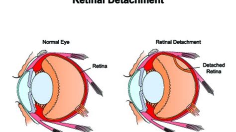 Detached Retina