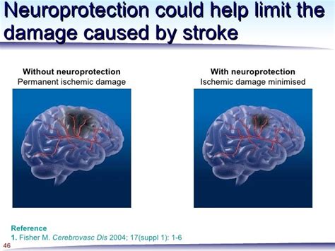 Neuroprotection In Stroke