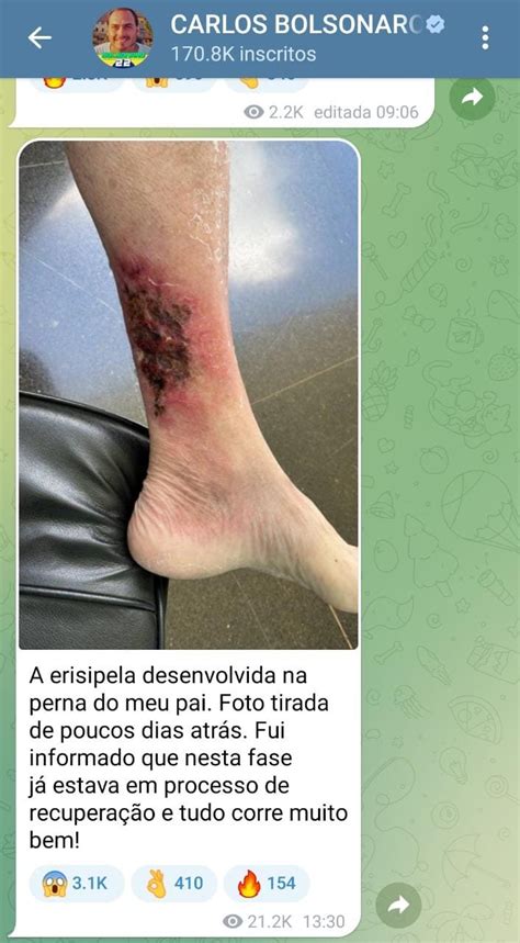 Carlos Bolsonaro publica foto da perna do pai erisipela MÍDIA HOJE