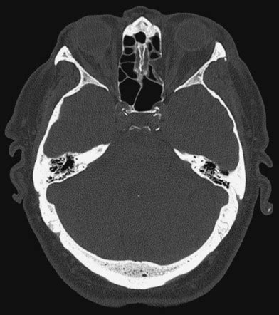 Orbital blowout fracture | Radiology Reference Article | Radiopaedia.org