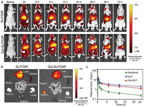 The Antitumor Activity Of Gal Slp In A Sorafenib Insensitive Hcc Pdx