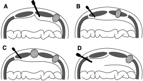 Schematic Of Extra Peritoneal Repair Options A Etep Approach With