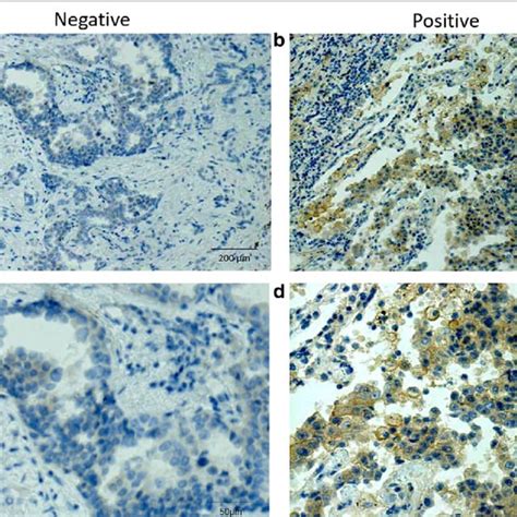 Representative Pd L1 Ihc Micrographs Of Negative And Positive Tumor Download Scientific Diagram