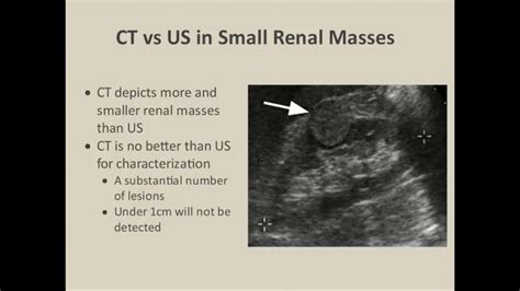 Renal Ultrasound Parenchymal Masses Youtube