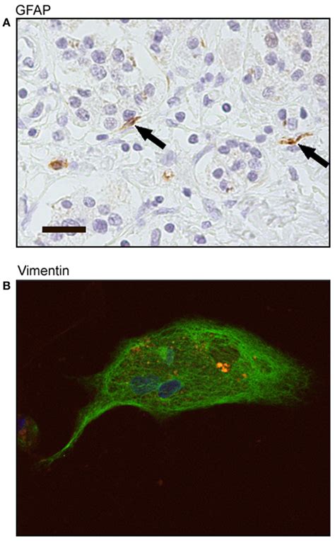 Frontiers Human Pancreatic Cancer Associated Stellate Cells Remain