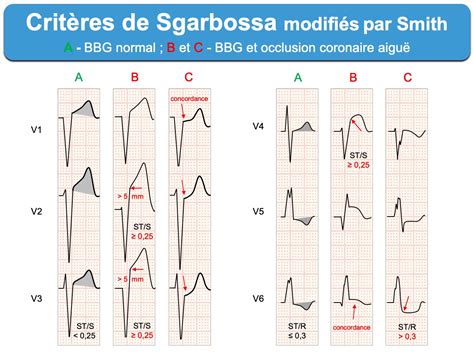 Infarctus C Bbg E Cardiogram