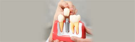 A Detailed Look At Dental Implant Healing Stages And Aftercare