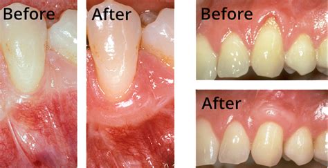 Kiwimethod Hands On Workshop Minimally Invasive Autogenous Gingival