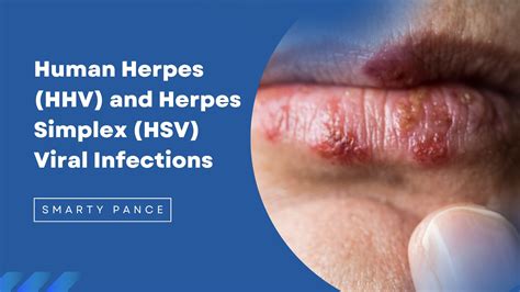 hsv infection herpes simplex virus infection consultant