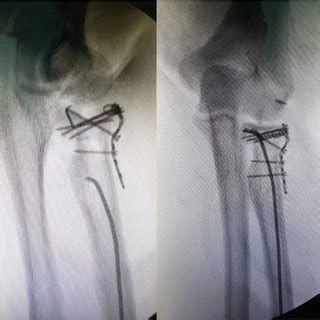 Typical Case Left Radial Head Fracture A Preoperative Radiograph