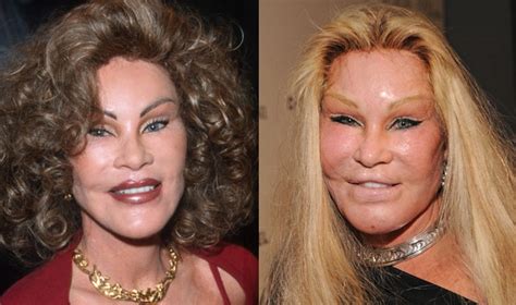 Celebrity Plastic Surgery Gone Wrong