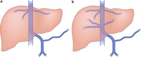 Portal Venous Shunt Liver