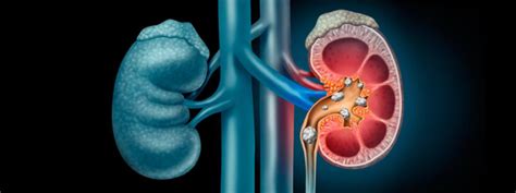 Como Ocorre A Forma O De C Lculos Urin Rios Urologia S O Luiz