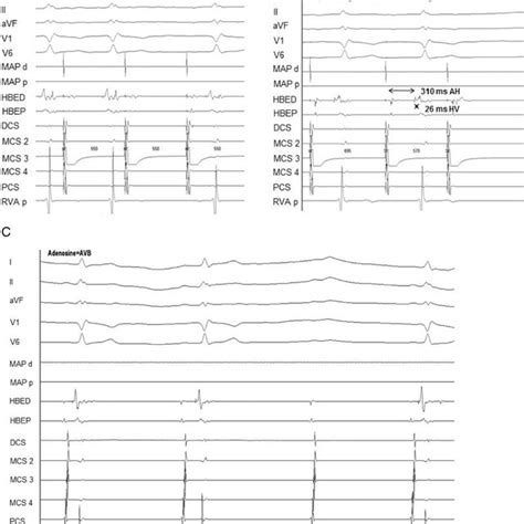 Case 2 Atrial Pacing And Adenosine Administration A Whereas Pacing Download Scientific