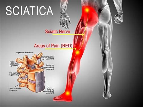 Can Osteopathy Help With Sciatica Better Health Osteopathy