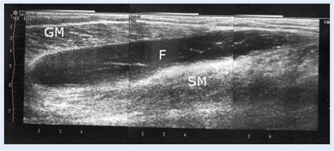 Figure 3 from Rupture of the medial gastrocnemius head (Tennis leg ...