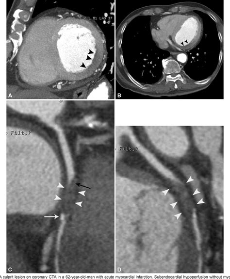 Figure 1 From Current Concepts Of Vulnerable Plaque On Coronary CT