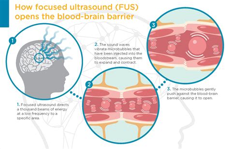 Als Researchers Take A Big Step Forward With Focused Ultrasound