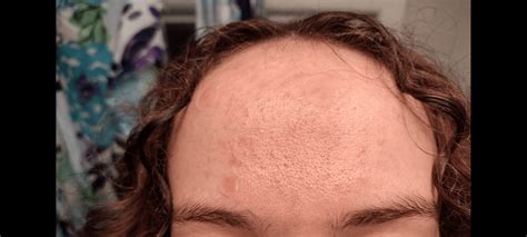 Can't get rid of these bumps!! [acne] : r/acne