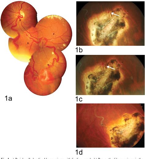 Table 1 From Treatment Of Retinal Capillary Hemangioma Using 810 Nm Infrared Laser Semantic