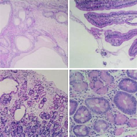 Microscopic pictures of gastric hyperplastic polyp, H&E, X40 (A ...