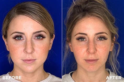 How To Get A Slimmer Face Effortbroad