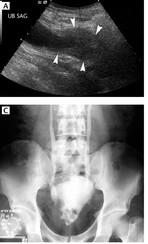 Bladder Cyst Ultrasound