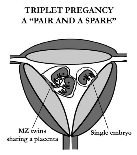 Womb Twin Survivors Multiples How To Tell Twins From Triplets