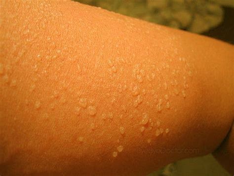 Why Sunburns Itch And How To Soothe Them Artofit