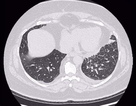 Interesting Case Of Female 54 Years Old Presented With Cough