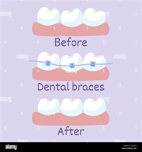 Stages Of Teeth Alignment Before And After Correction With Brackets