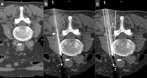 Percutaneous Core Needle Biopsy For Para Aortic Retroperitoneal Lesions