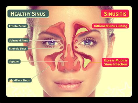 Are Sinus Infections Contagious Through Kissing