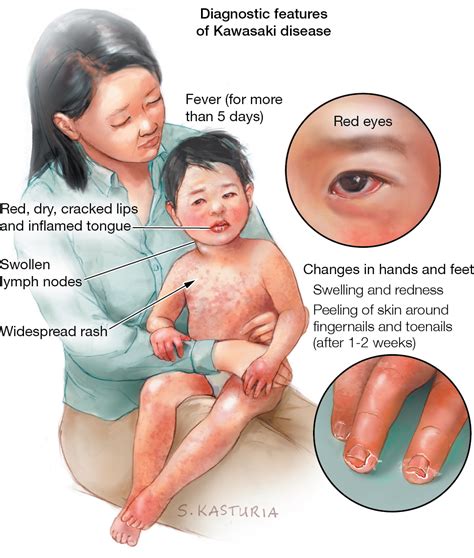 Kawasaki Disease Cardiology Jama Jama Network