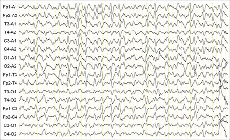 The Synchronous Triphasic Sharp Waves Were Seen In The Frontal