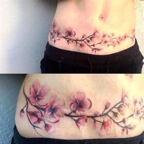 Tummy Tuck Scar Tattoo Dadmilo