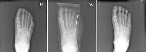 A Preoperative Standing Anteroposterior Radiograph Shows A Foot With