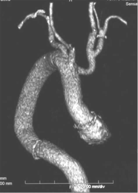 Surgical Repair For Aortic Dissection Accompanying A Right Sided Aortic