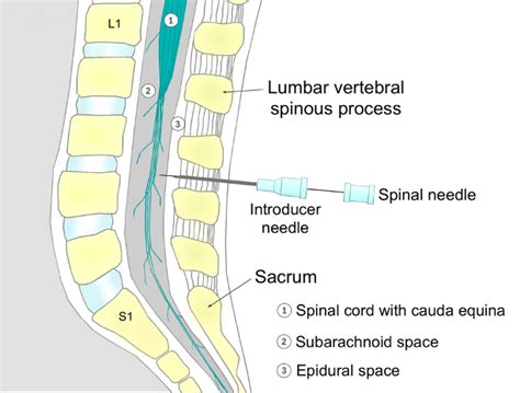 Spinal Anesthesia In Adults Anatomy Indications And Physiological