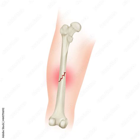 Nondisplaced Bone Fracture Femoral Shaft Fracture Stock Illustration