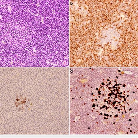 Left Cervical Lymph Node Biopsy Specimen A Diffuse Proliferation Of Download Scientific