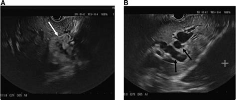 Endoscopic Ultrasound Shows A Hyperechoic Mass White Arrow In Image A Download Scientific