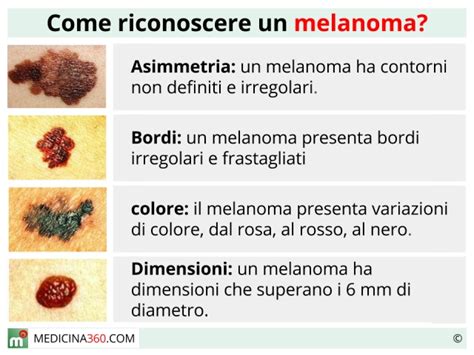 Melanoma Maligno O Benigno Sintomi Cura E Sopravvivenza