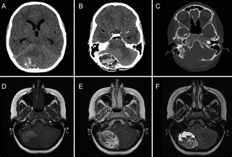 Aneurysmal Bone Cyst Spine Mri