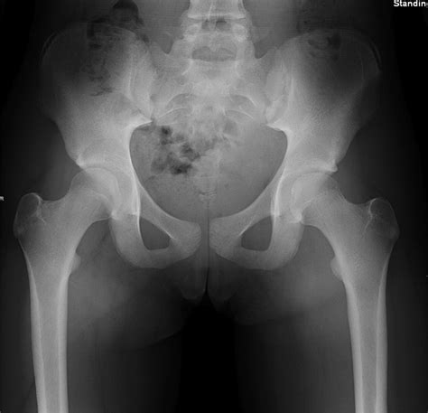 AP Pelvis Radiograph Without Bony Or Soft Tissue Abnormalities