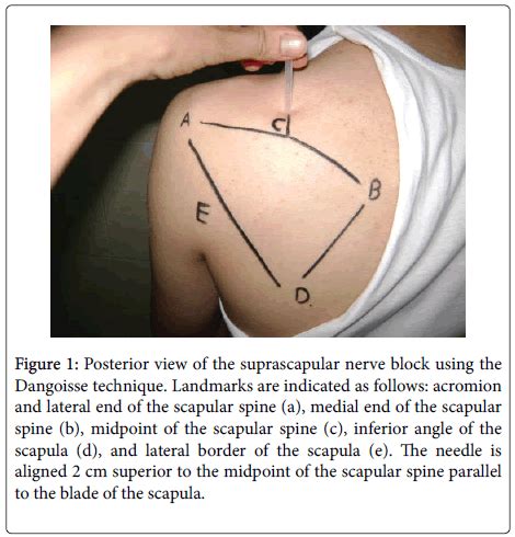 Suprascapular Nerve Block Followed By Codman S Manipulation And H